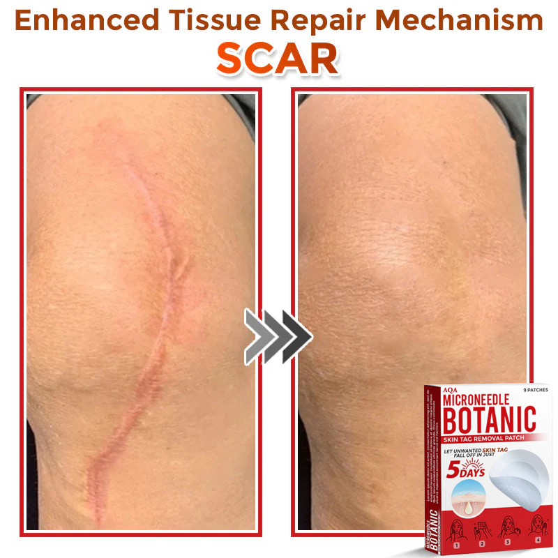 AQA® Botanical MicroNeedle Skin Tag Removal Patches – Safe & USA-Made