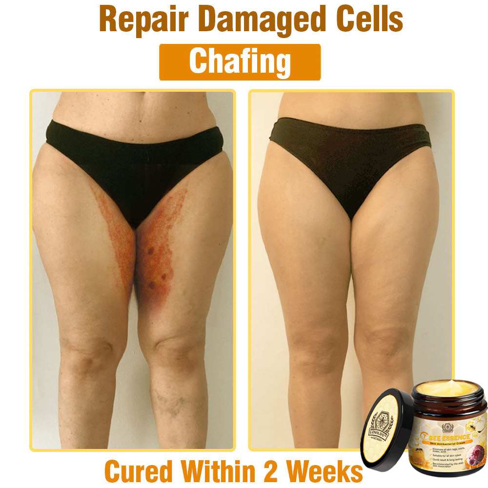 LOVILDS™ Bee Essence Skin Antibacterial Cream—used to treat a variety of skin diseases (AAD recommended)`