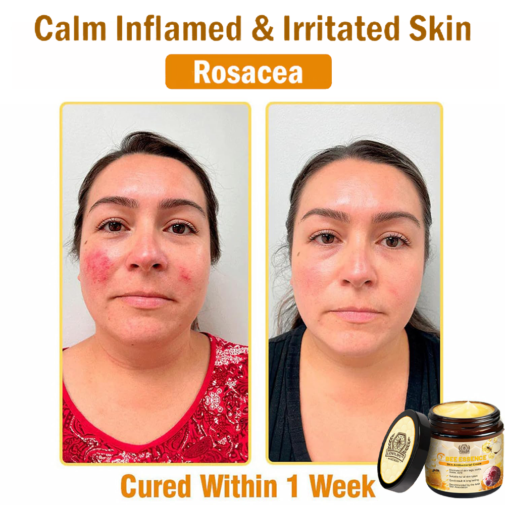 LOVILDS™ Bee Essence Skin Antibacterial Cream—used to treat a variety of skin diseases (AAD recommended)`