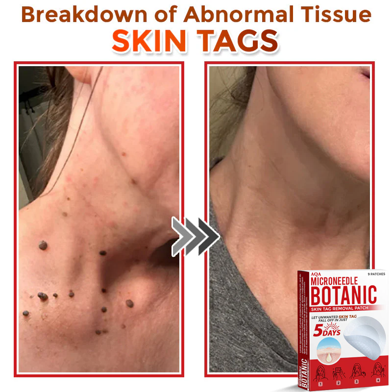 AQA® Botanical MicroNeedle Skin Tag Removal Patches – Safe & USA-Made