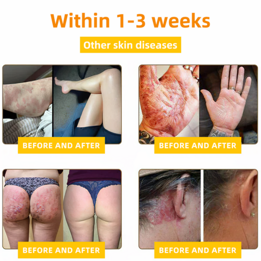 LOVILDS™ Bee Toxin Skin Repair Cream(AAD Recommended👨⚕️)`