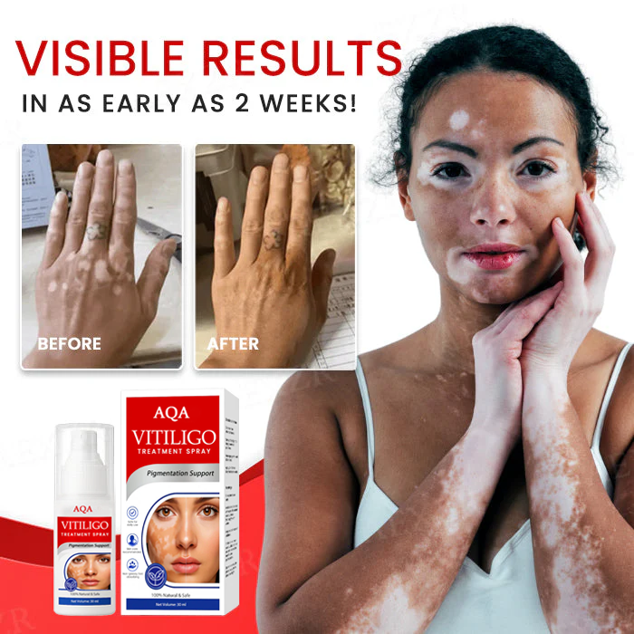 🔥 FDA & WHO Approved | AQA® Vitiligo Spray 🌍 Fast Results ⚡ Gentle & Allergy-Free 🌸 Trusted by 150,000+ Customers 📦