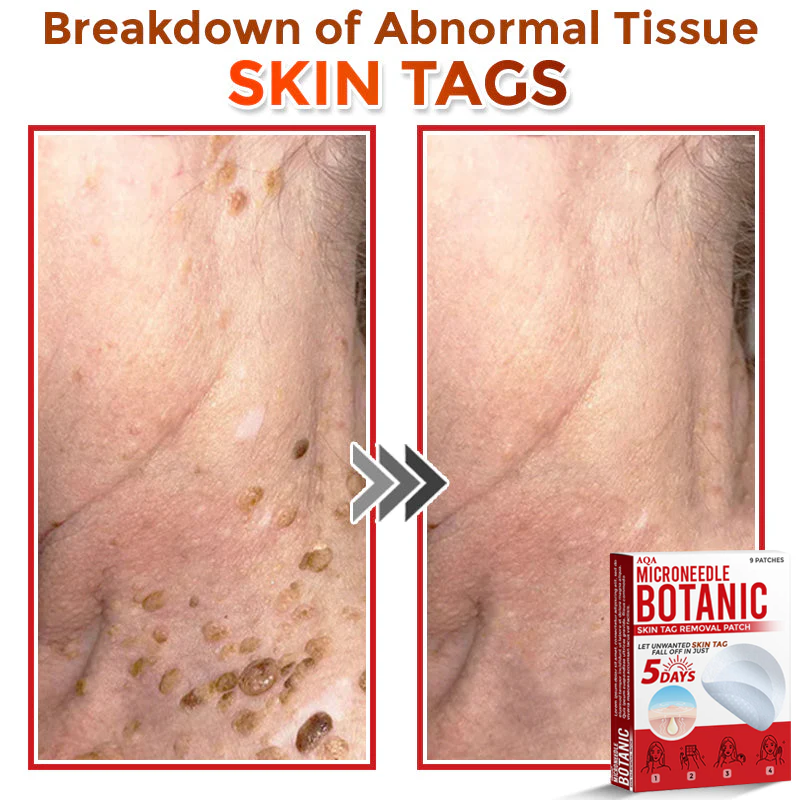 AQA® Botanical MicroNeedle Skin Tag Removal Patches – Safe & USA-Made
