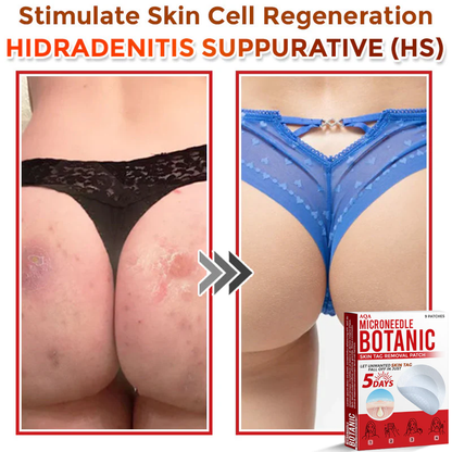 AQA® Botanical MicroNeedle Skin Tag Removal Patches – Safe & USA-Made